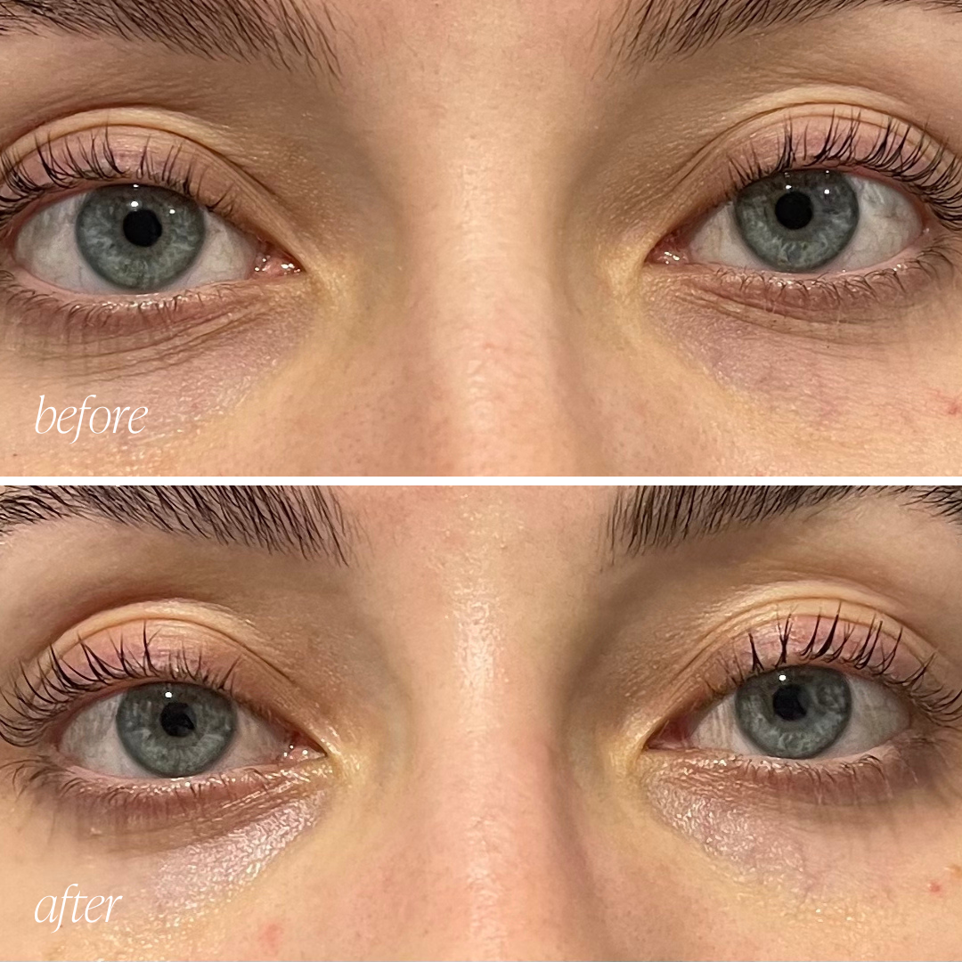 Before and after eye cream results showing reduced puffiness and brighter under-eyes in 28 days