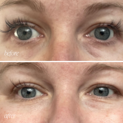 Before and after eye cream results showing reduced puffiness and brighter under-eyes in 28 days