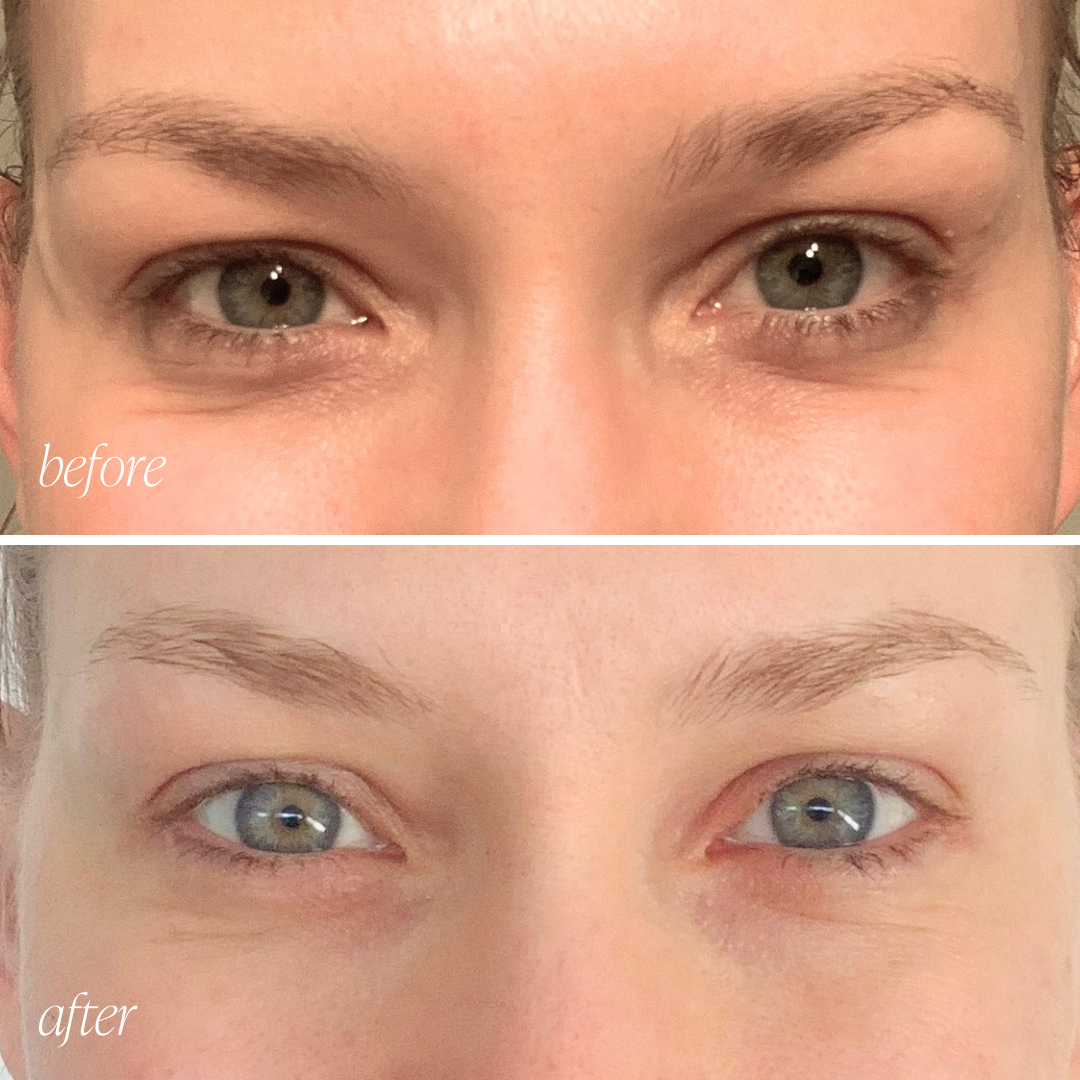 Before and after eye cream results showing reduced puffiness and brighter under-eyes in 28 days